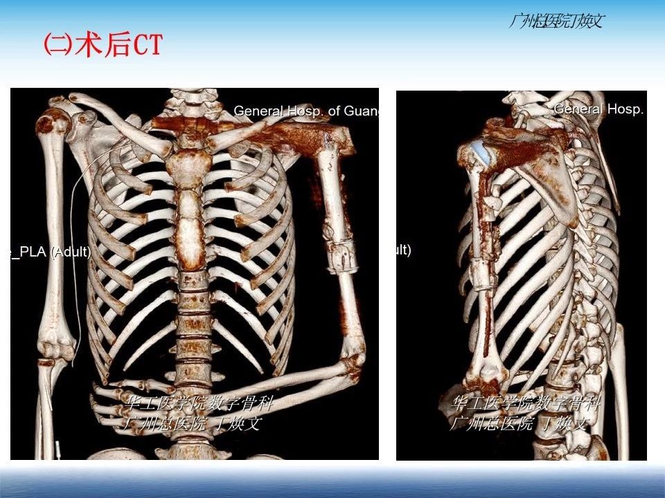 【病例分享】丁焕文主任:左肱骨近端肿瘤数字化精准切除和重建术