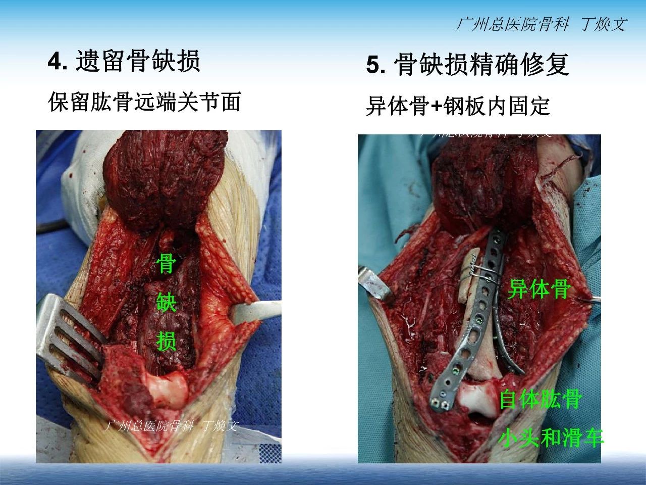 【病例分享】丁焕文主任:右肱骨下段骨肿瘤并病理性骨折