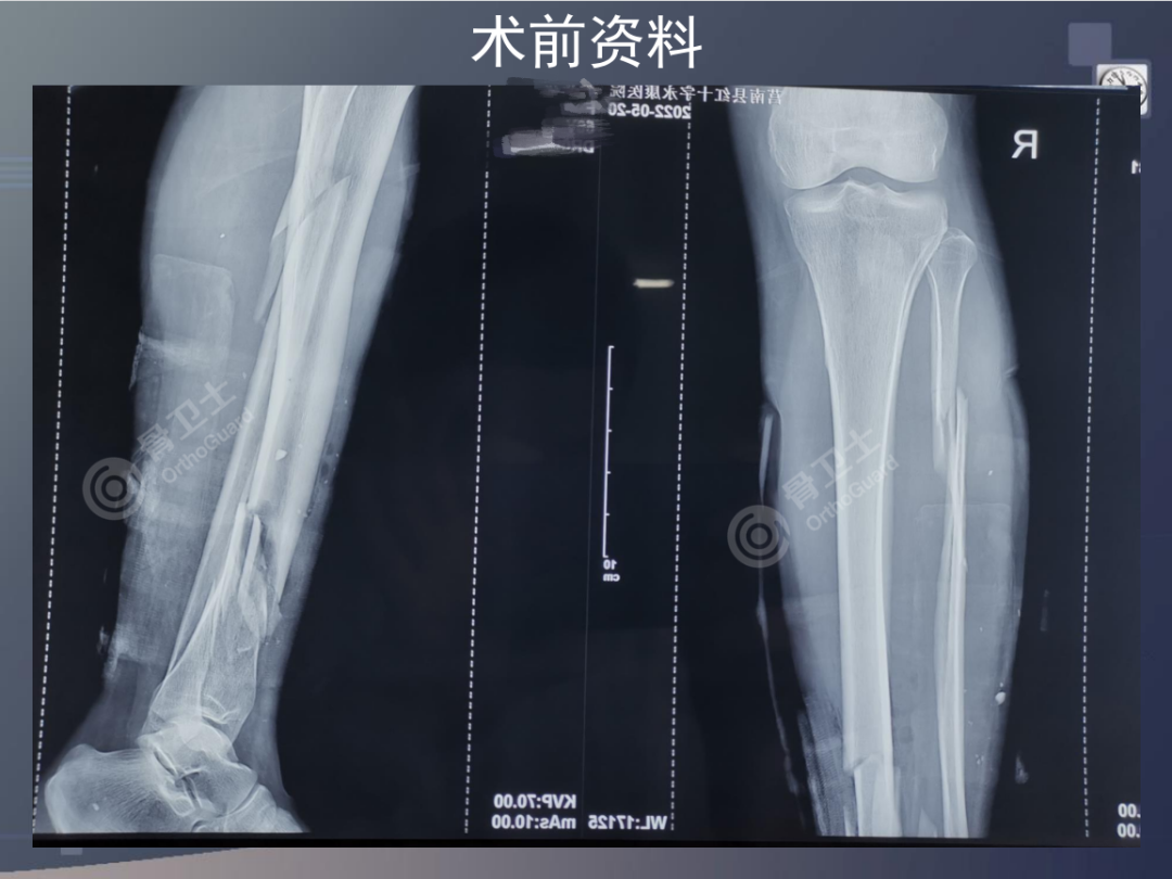 大腿骨近位部骨折の治療｜整形外科｜千船病院【大阪市】